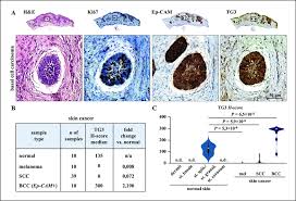 Looking for a good deal on tg3? Tg3 Is Highly Expressed In Ep Cam Basal Cell Carcinoma A H E Download Scientific Diagram
