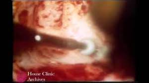 Endolymphatic Subarachnoid Shunt For Meniere S Disease Youtube