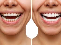 Smile Makeovers | Eagle Family Smiles