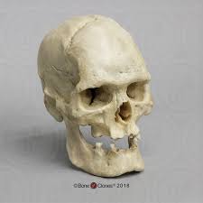 Image result for Acromegaly
