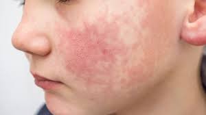Image result for Rubella