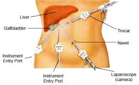 Gallbladder Removal Laparoscopic Procedure Leaves Only 4 Tiny Marks Laproscopic Surgery Laparoscopic Surgery Gallbladder Surgery