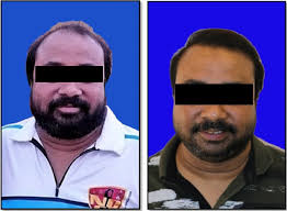 Alopecia facial hair but then again, in some cases we shed a lot of hair really promptly, or the hair quits expanding back. Beard A Potential Donor Site In Grade 6 And Grade 7 Alopecia A Case Series Springerlink
