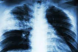 A pneumonia causada pelo streptococcus pneumoniae é a pneumonia bacteriana mais comum. Pneumonia Causa Sintomas Tratamento E Prevencao Brasil Escola