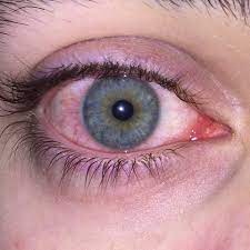 Meine Auge Ist Rot Was Tun Medizin Augen Entzundung