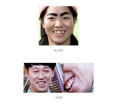 일본인 치열에 대한 이미지 검색결과