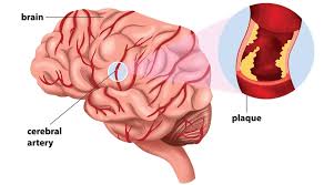 Bildergebnis für CVA
