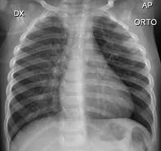 Covid 19 Pneumonia Pediatric Radiology Case Radiopaedia Org