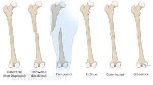 Bone Break Vs Fracture Types Of Bones Types Of Fractures Fracture