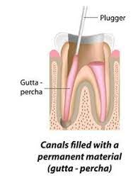 The Rootcanal Procedure Canals Filled With A Permanent Material Gutta Percha Root Canal Root Canal Dentist Root Canal Treatment