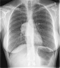 We did not find results for: Solitary Fibrous Tumor Wikipedia