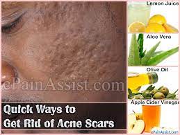 Quick Ways To Get Rid Of Acne Scars
