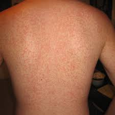 Image result for sweat rash on back
