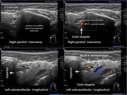 Image result for Submandibular Exam