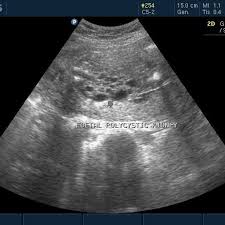 Bilateral Polycystic Kidney In Utero Eurorad