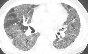 Acute Exacerbation Of Idiopathic Pulmonary Fibrosis Frequency And Clinical Features European Respiratory Society