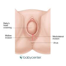 Episiotomy What It Is And When It S Needed Babycenter