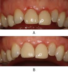 Image result for Gingivitis