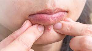 Leave acne to the experts — get acne care from a real provider with 1 short quiz. Picked Your Skin Dr Pimple Popper On What To Do To Heal Quickly Rachael Ray Show