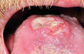 Nearly 115,000 new cases of syphilis have been diagnosed in the year 2018 alone, as per the centers for disease control and prevention (cdc) reports. Syphilis On The Face In Primary Care A Rare Sign Of An Increasingly Common Problem British Journal Of General Practice