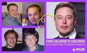 Elon thinning hair system for early stages of hair loss with matrix 5,000. Everything About Elon Musk S Hair Transplant Hair Transplant Plastic Surgery In Istanbul Turkey Mcan Health