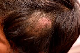 This will depend on several factors like how sensitive you are, what sort of. Fungal Skin Infections Health Information Bupa Uk