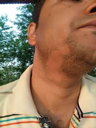 Alopecia areata or hair loss in patches not only affects the scalp, it can also affect the beard, eyebrows and moustache. Patchy Hair Loss Of Beard Alopecia Barbae Cured By Classical Homeopathy Case Study