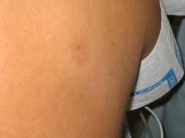 A sharp pain like a pinprick, or pain that spreads from the bite area to other areas. An Example Of A Black Widow Spider Bite Showing An Oval Targetlike Download Scientific Diagram