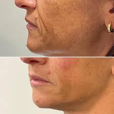 Corrección del SURCO NASOGENIANO Y LINEA DE MARIONETA con el relleno de  acido hialuronico y reposición de volúmenes óseos en tercio medio.  #acidohialuronico #surconasogeniano #medicinaestetica