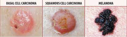 If you've received a diagnosis, here are some things you need to know about the condition. Skin Cancer Types Symptoms Melanoma Treatment