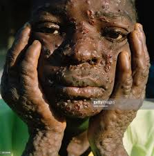 Monkeypox is a rare, infectious disease that is caused by the monkeypox virus. Monkey Pox What You Need To Know Green Earth Ng
