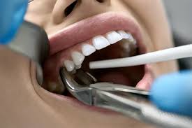 Image result for Tooth Extraction