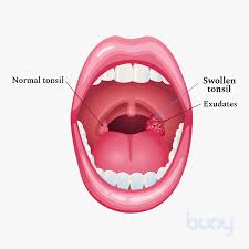 Image result for Strep throat infection roof of mouth