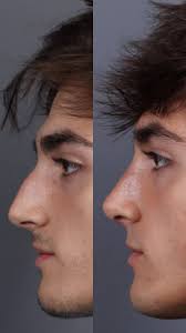 Check out this stunning rhinoplasty transformation by RealSelf Verified Dr.  James Marotta! (@marottaplasticsurgery) 👃✨ Want to see more of his amazing  before & after photos and read real patient ...