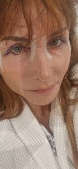 Anyone get fillers under the eye area? I just did and it looks bumpy.