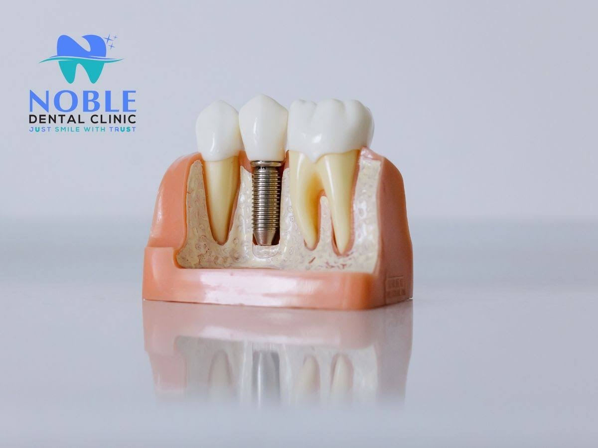 Implant product image