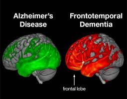 What is Frontotemporal Dementia?? - The Ruby Pardue Blackburn Adult Day  Health Care Center
