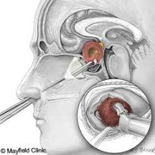 Endoscopic Transsphenoidal Surgery Pituitary Tumor Surgery Pituitary Gland Tumor Brain Tumor Awareness Adrenal Insufficiency
