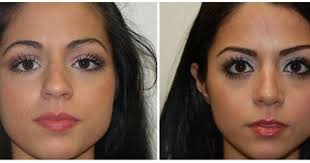 Rhinoplasty Nose Job Miami Rhinoplasty Nose Surgery Rhinoplasty Nose Plastic Surgery