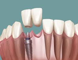 Image result for dental implant