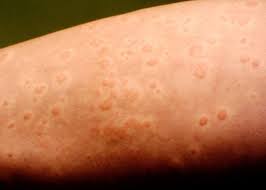 Home remedies to treat skin allergies naturally. Ayurveda For Urticaria Shathayu Ayurveda Yoga Retreat
