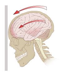 Signs and symptoms of concussion. Concussion Wikipedia