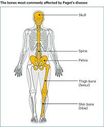 The spinal process is perhaps the most prominent, jutting out like a wing. Paget S Disease Of Bone Causes Symptoms Treatments