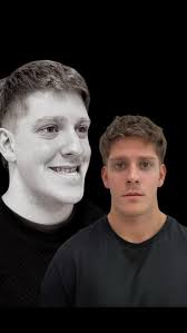 🇺🇸 Extreme case of cocaine abuse. Patient with total destruction of the  palate and nasal cavity due to cocaine use. A few years ago we had made a  3D printed prosthesis that