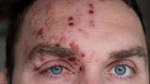 Image result for shingles