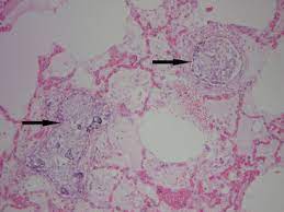 Mcconnell's sign or acute regional rv dysfunction. Pulmonary Tumor Embolism A Rare Cause Of Acute Right Heart Failure With Elevated D Dimers Journal Of Thoracic Oncology