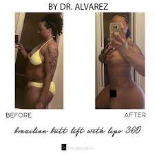 Mia aesthetics is a plastic surgery clinic with locations in miami, austin, la s vegas, chicago, atlanta. Mia Aesthetics Beautiful Bbl With Lipo 360 By Facebook