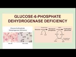 Image result for G6PD Deficiency Detection