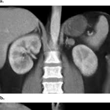 In our study, bilateral adrenal visualisation was achieved in almost all cases, and electronic callipers in pacs facilitated more accurate measurements. Pdf Adrenal Mass Imaging With Multidetector Ct Pathologic Conditions Pearls And Pitfalls