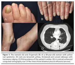 Image result for Yellow nail syndrome feet